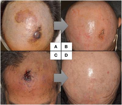 Cutaneous Angiosarcoma: The Possibility of New Treatment Options Especially for Patients with Large Primary Tumor